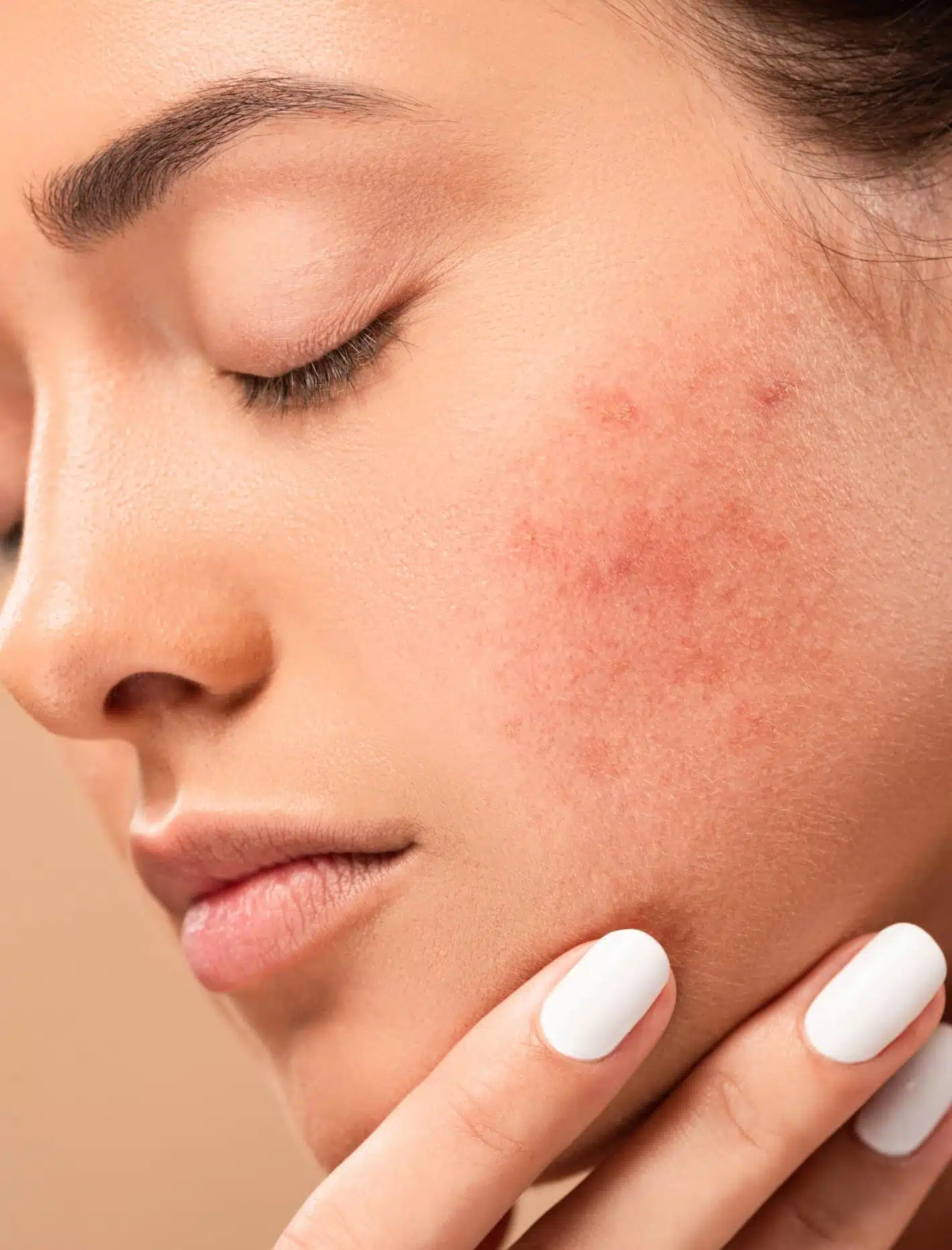 La couperose du peau du visage d'une femme pour traitement Au centre esthetique Tremoille a paris au 8eme