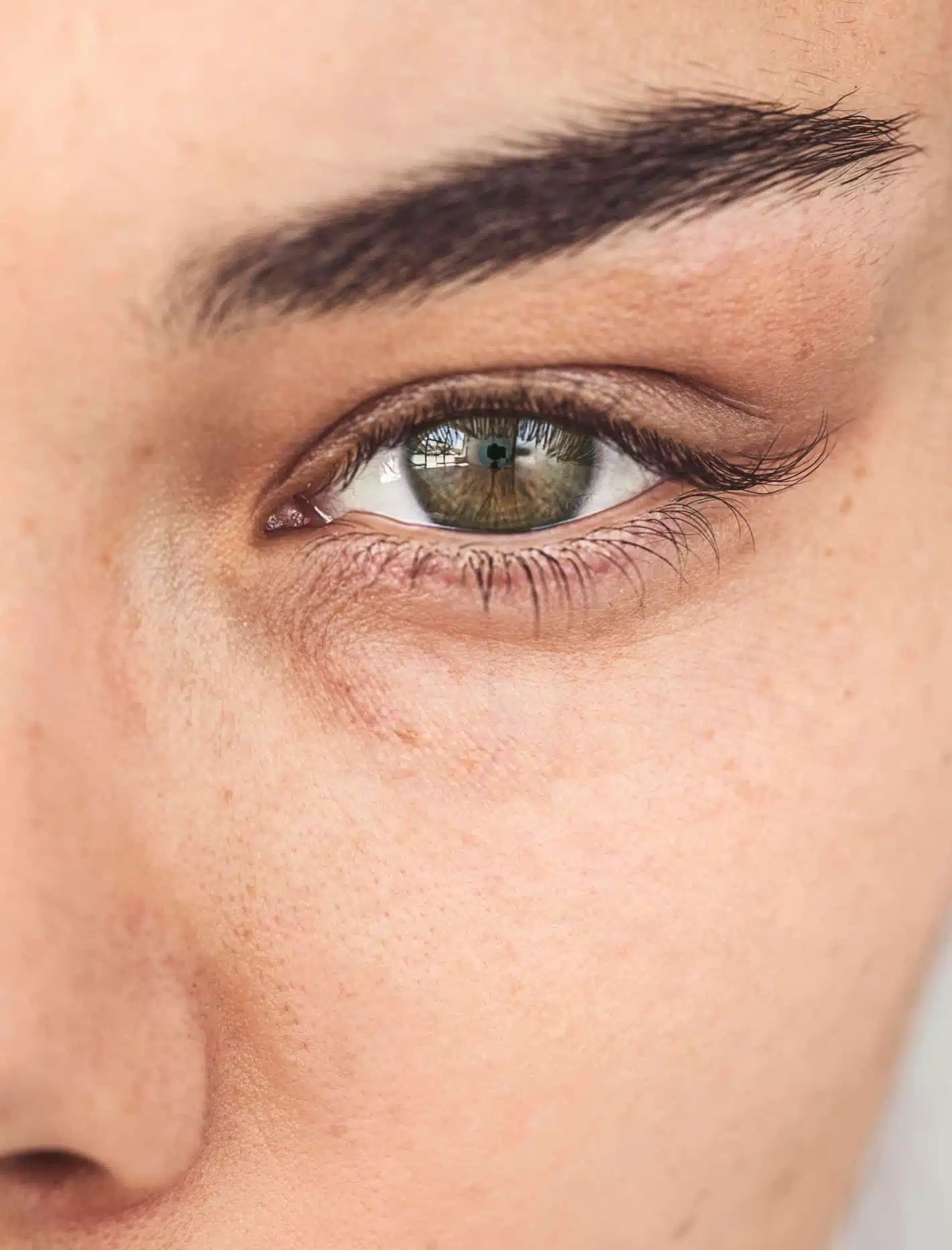 Femme avec cernes avant traitement Au centre esthetique et laserTremoille a paris au 8eme