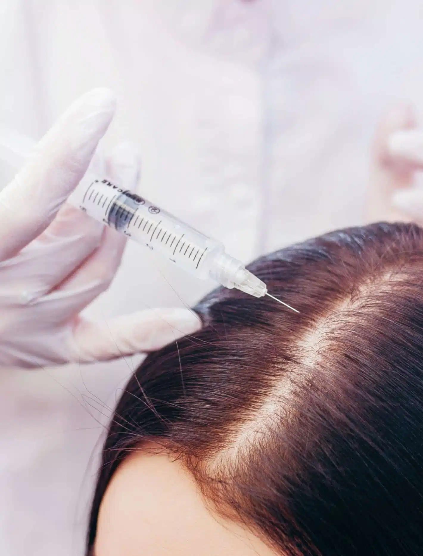 contenu-prp-microneedling-cheveux.jpg