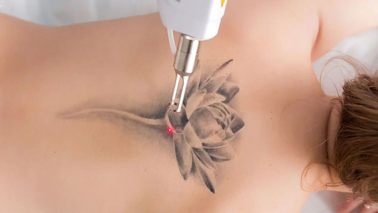 Enlever le tatouage à Paris | Centre Esthétique Trémoille