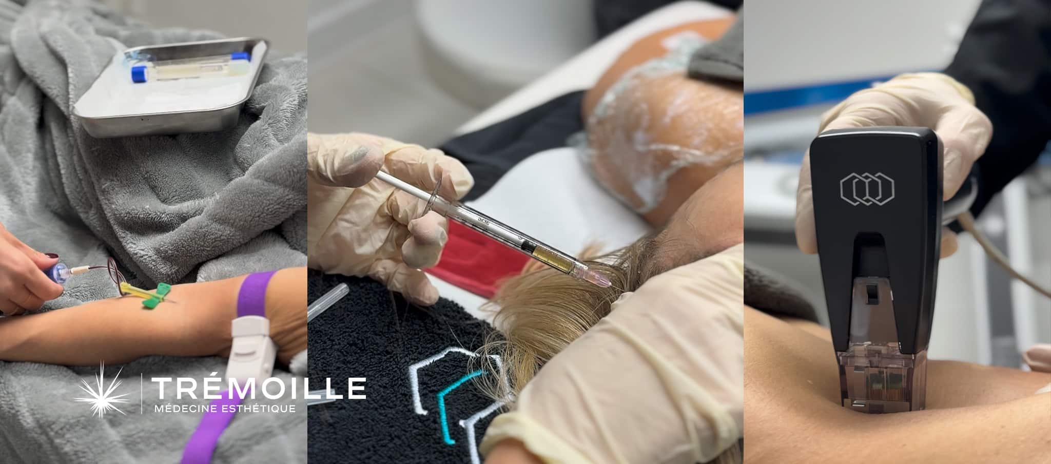 Morpheus 8 et Injections PRP combinées à vitaminothérapie pour régénération cutanée Paris 8