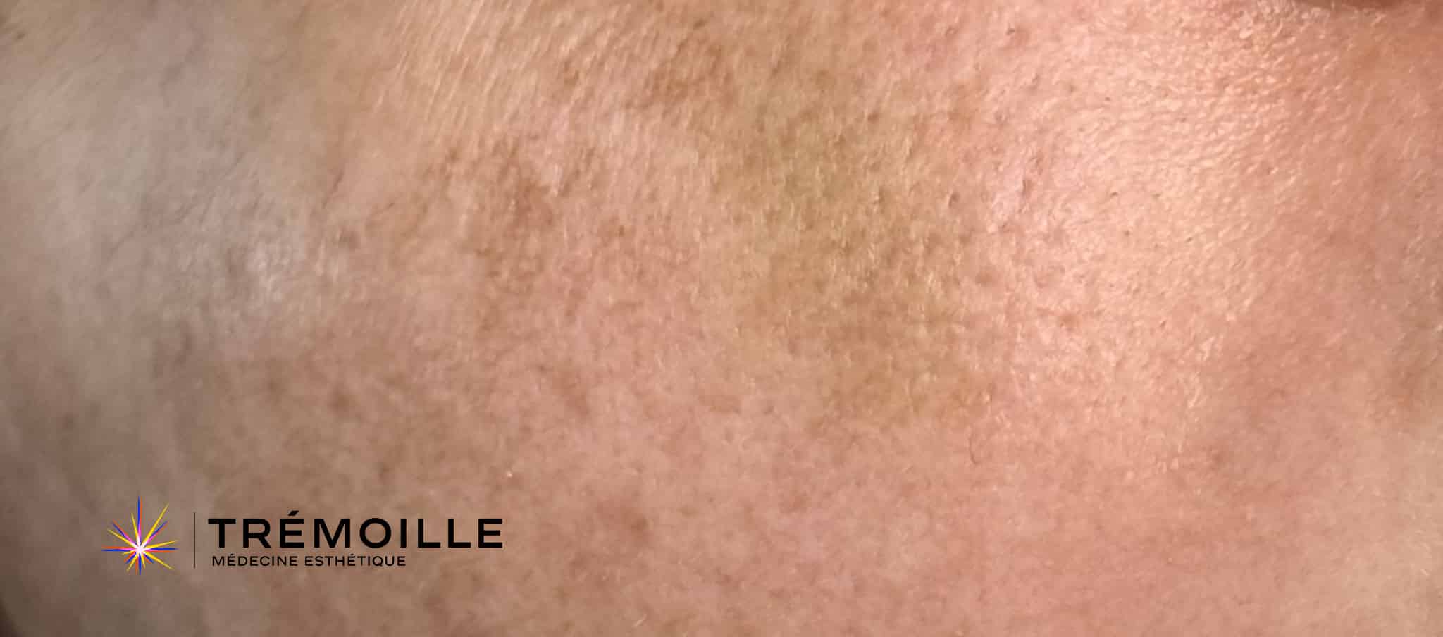 Traitement tâches de soleil post été melapeel