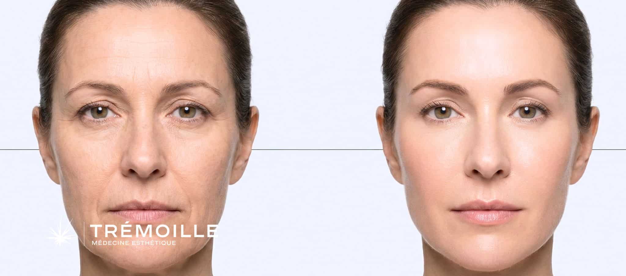 Avant/après protocole combiné anti-âge visage Paris 8 : amélioration rides, éclat et fermeté après 12 semaines de traitement Botox + peeling + skinbooster + LED