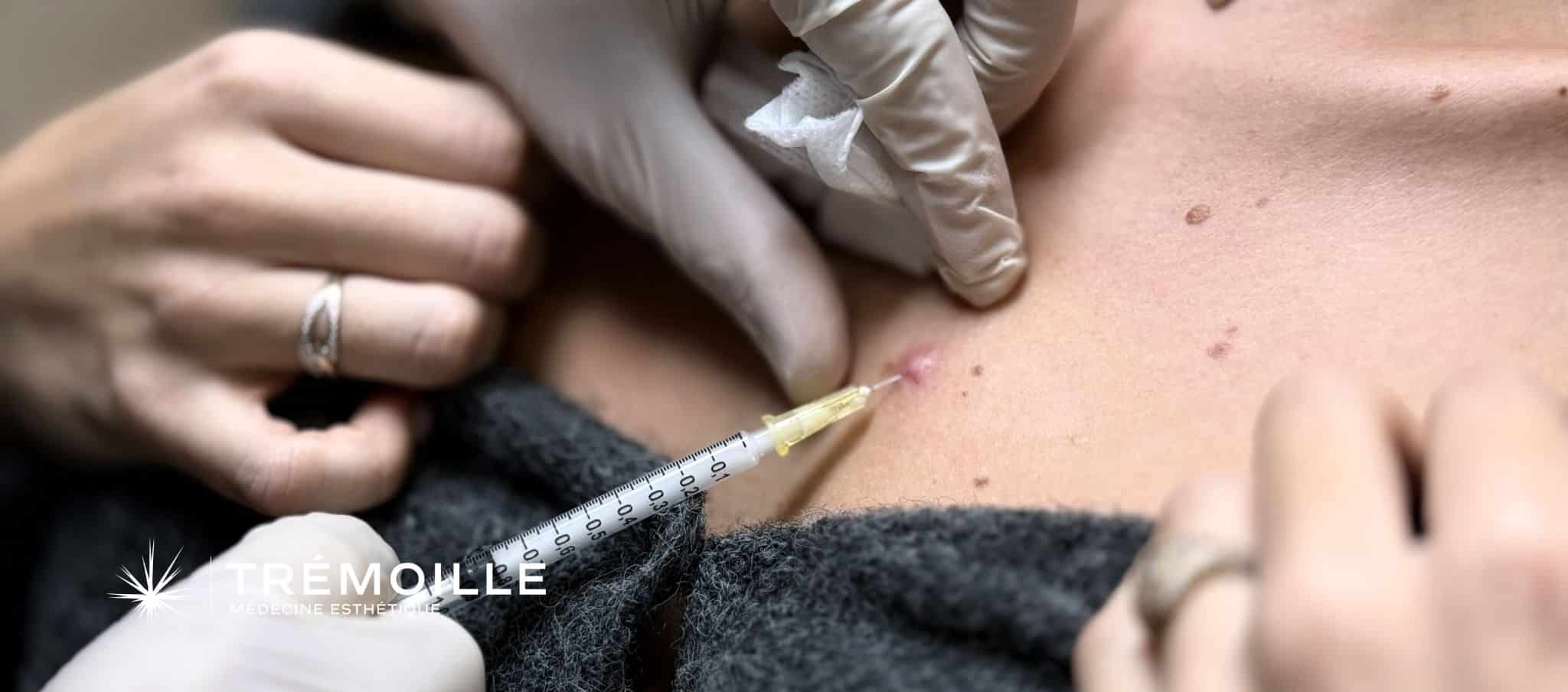 mauvaise cicatrisation après chirurgie