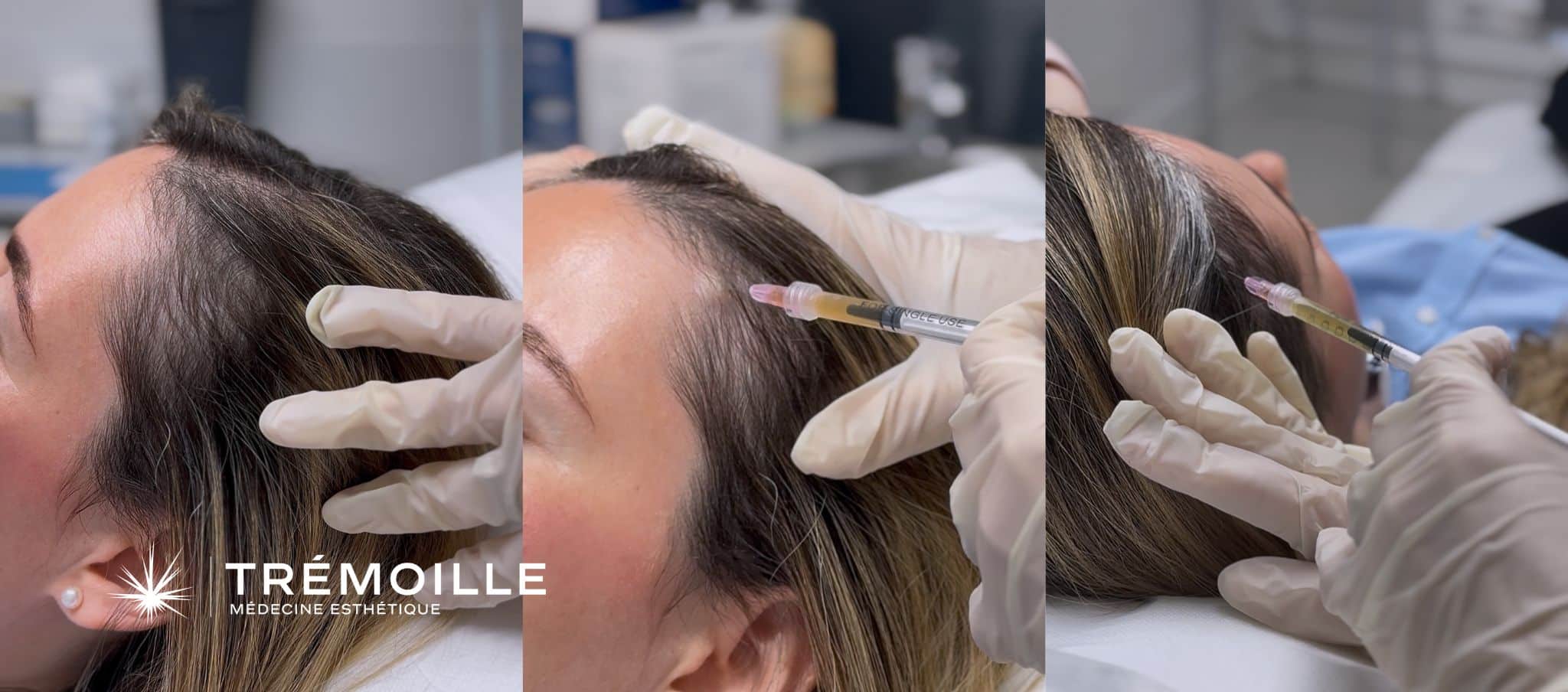 PRP cheveux post-partum