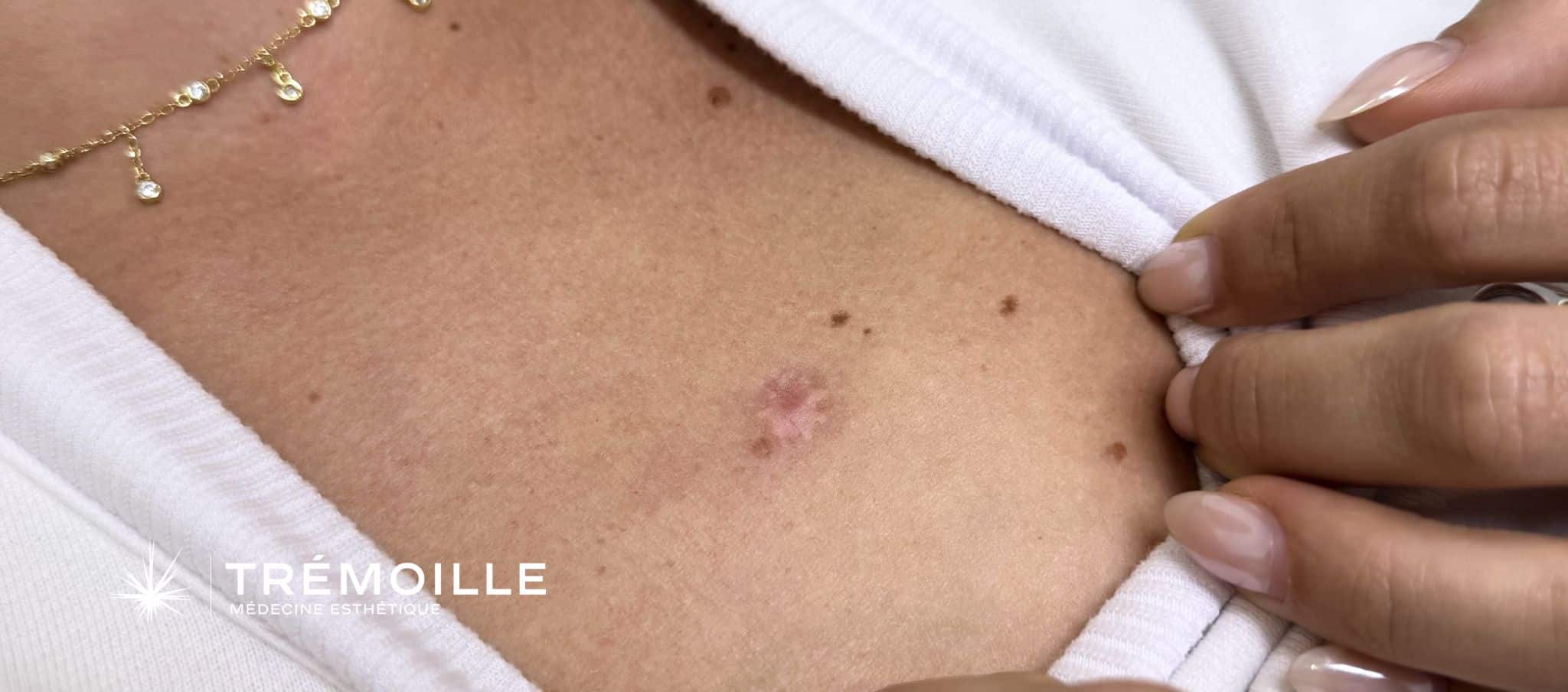 cicatrice chéloïde post-opératoire