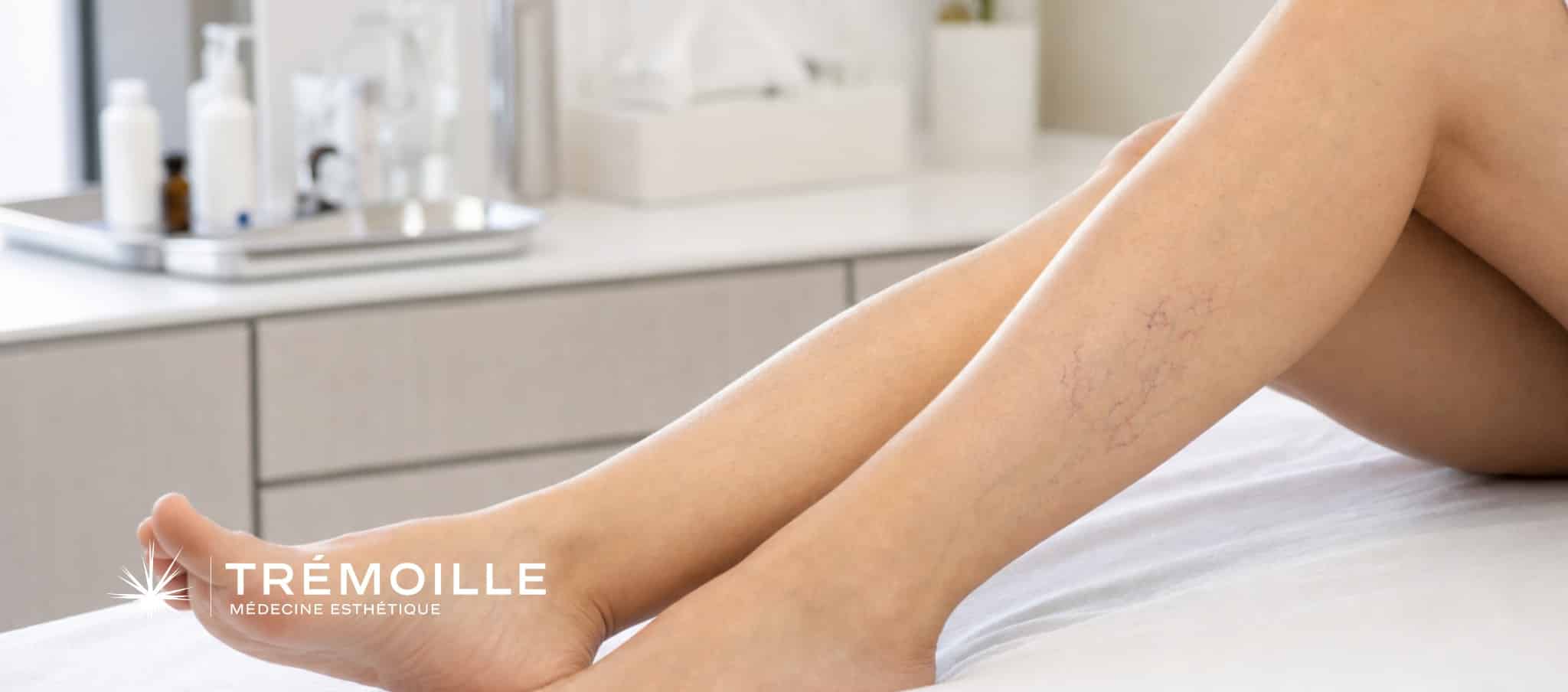 Visuel Centre Trémoille sur la sclérothérapie des varicosités
